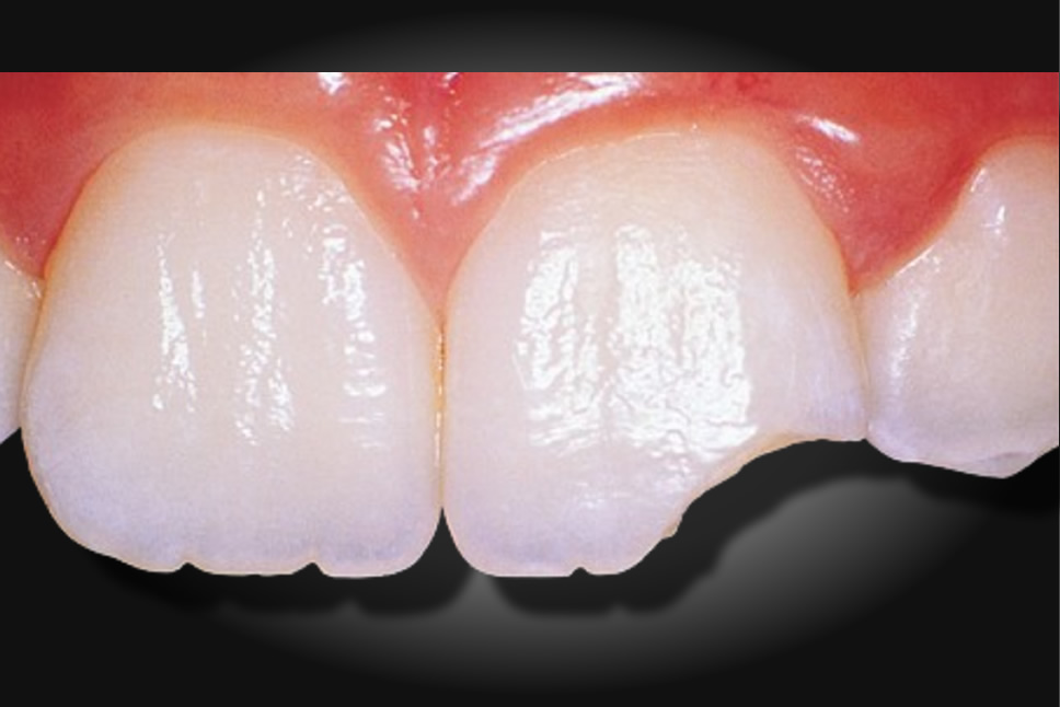 tratamento bruxismo icarai niteroi